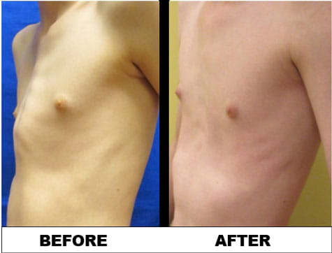 Pectus patient (12 years old) before surgery and after surgery photo.